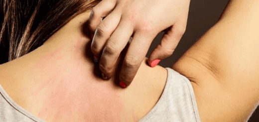 a woman's allergic skin